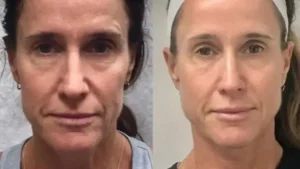 Lift and Tighten Your Skin with Ultherapy Charleston, SC – Well Labs+ MedSpa Charleston